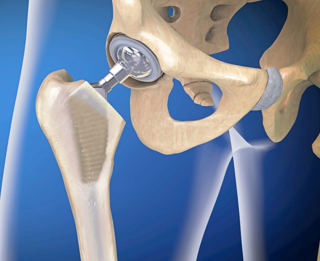tantalum hip joint replacement